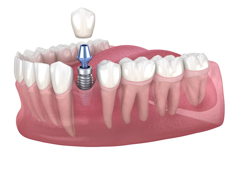 Dental Implants